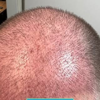 Haartransplantation - davor vs. danach😍