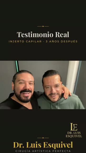 Tres años después de su injerto capilar.

Lo que él destaca es la naturalidad: la línea del cabello 