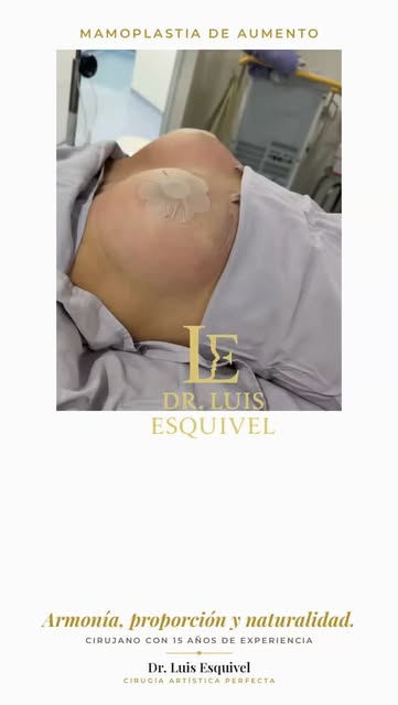 Aumento de busto con implantes. La armonía en este procedimiento no está en el volumen que se agrega