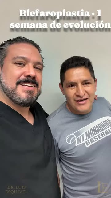 Una semana después de su blefaroplastia. Molestias mínimas, recuperación rápida y un paciente que ya