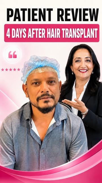 4 days after hair transplant — and the biggest surprise? How comfortable the recovery can feel.

No 