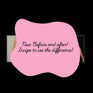 ✨ A beautiful transformation ✨

This patient’s journey included a tummy tuck, breast lift, and flank