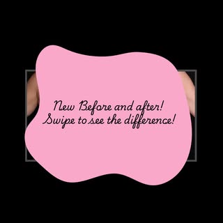 A breast lift paired with a tummy tuck can restore shape, improve contour, and help create a more ba