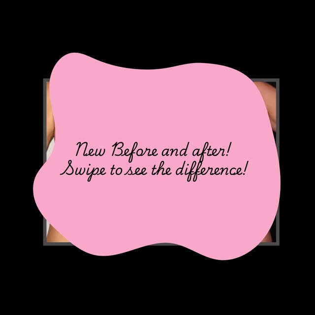This before-and-after features a tummy tuck and breast augmentation, creating a more contoured abdom
