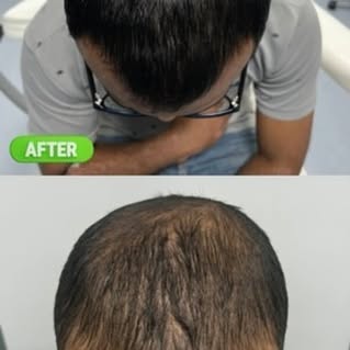 🌟 Witness Amazing Transformations at AHI Clinic 🌟

👨‍⚕️ Led by Dr. Waqas Chaudhary, our clinic sp