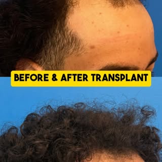 Let’s talk about how we planned a hair transplant for our 18 year old patient and review the results