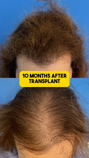 Let’s hear from one of our patients 10 months after her hair transplant procedure! #hairloss #hairlo
