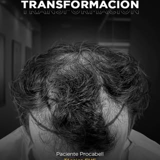 No es solo cabello... ¡es recuperar tu seguridad!
Ver la sonrisa de nuestros pacientes al ver sus re
