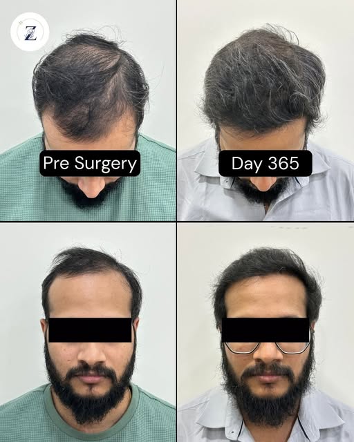 Grade IV hair loss? Once upon a time, that meant limited options today, it's just the starting point