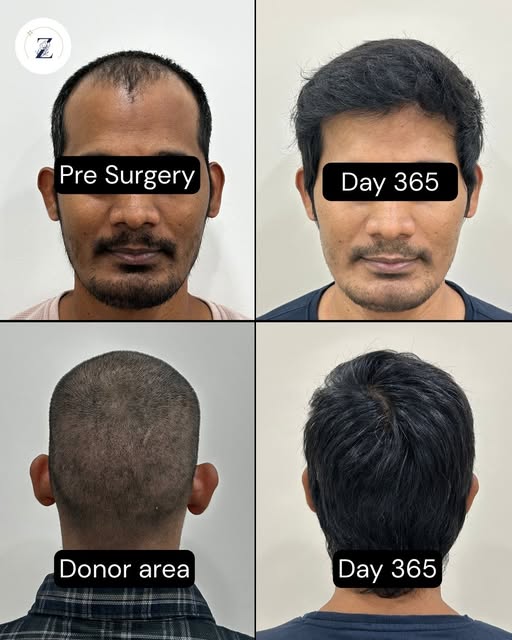 Confidence isn't just grown back, it's earned, strand by strand, graft by graft. 2600 grafts and 12 
