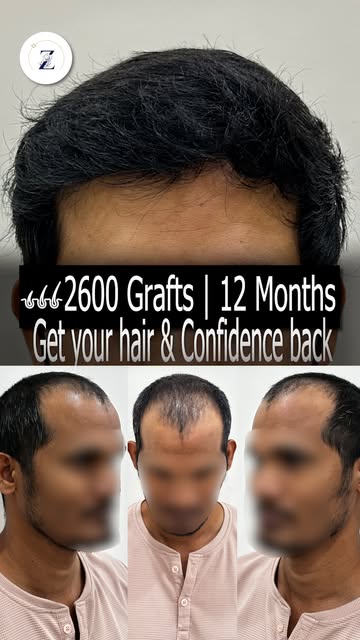 From pre-surgery doubts to a full head of confidence in just 365 days, this is what patience, precis