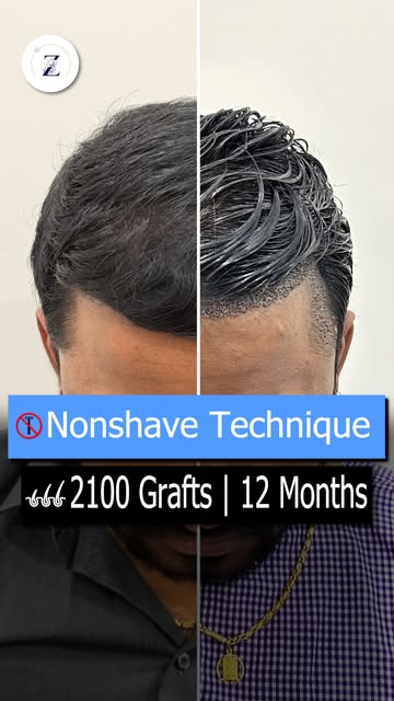 No shave, no giveaway, just a hairline that quietly transforms your whole look.

The nonshave techni