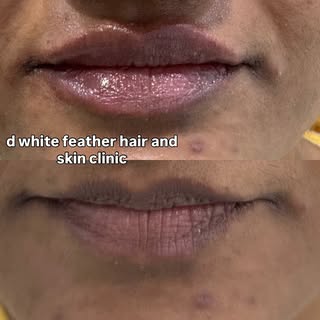 Lips that look naturally fuller, never fake. 💉💋
Whether you want better definition, improved symme