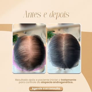 Resultado de tratamento personalizado e combinado, (clínico, tópico e oral). 
Já conseguimos ver uma