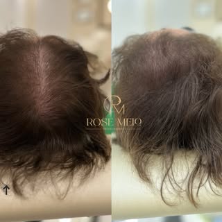 @rosemelotricologista

Nem todo mundo entende a dor de olhar no espelho e ver o cabelo ficando cada 