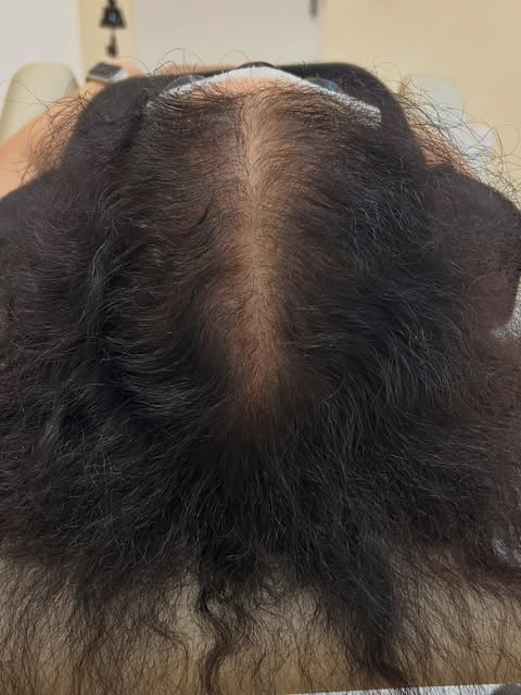 Já imaginou uma pessoa passar 10 anos tentando recuperar o cabelo.? 
E olhe que hoje, ainda estamos 