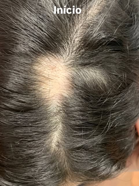 ✨ Quando o resultado fala por si.

Essas fotos foram enviadas pela própria paciente para mostrar a e