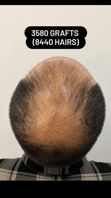 Entire procedure performed by Dr. Alexis.
Micro FUE Hair Transplant. No cuts or noticeable scars.

#