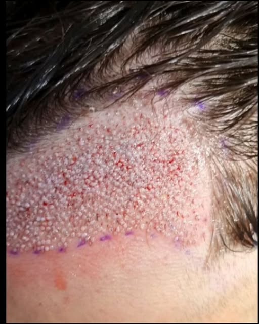 When the request is for DENSE.

Entire procedure performed by Dr. Alexis.
Micro FUE Hair Transplant.