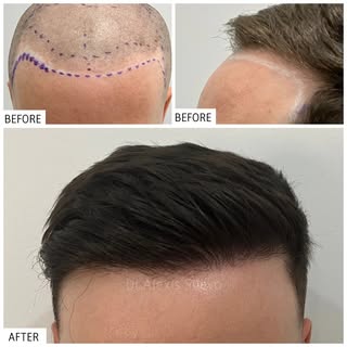 Lowering + strengthening of frontal hairline. Entire procedure performed by Dr. Alexis.
Micro FUE Ha