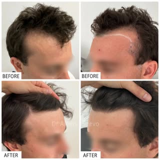 Entire procedure performed by Dr. Alexis.
Micro FUE Hair Transplant. No cuts or noticeable scars.

#