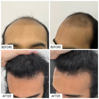 Entire procedure performed by Dr. Alexis.
Micro FUE Hair Transplant. No cuts or noticeable scars.

#