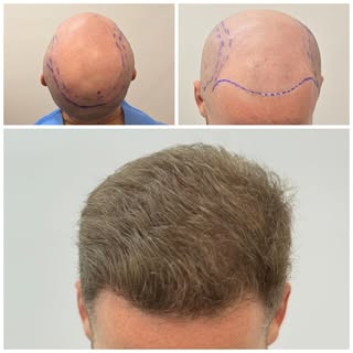 Entire procedure performed by Dr. Alexis whilst at Hairline Clinic.
Micro FUE Hair Transplant. No cu