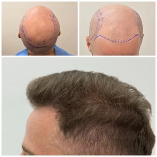 Side profile.

Entire procedure performed by Dr. Alexis whilst at Hairline Clinic.
Micro FUE Hair Tr