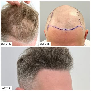Entire procedure performed by Dr. Alexis.
Micro FUE Hair Transplant. No cuts or noticeable scars.

#