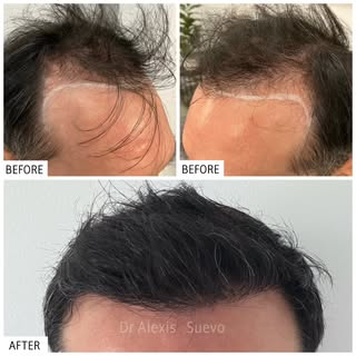 Entire procedure performed by Dr. Alexis.
Micro FUE Hair Transplant. No cuts or noticeable scars.

#