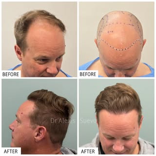 Entire procedure performed by Dr. Alexis whilst at Hairline Clinic.
Micro FUE Hair Transplant. No cu