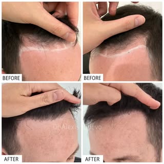 Entire procedure performed by Dr. Alexis.
Micro FUE Hair Transplant. No cuts or noticeable scars.

#