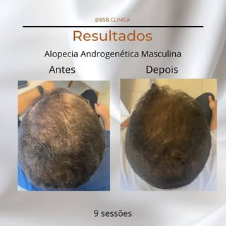 👉🏻 Paciente sexo masculino, estava buscando um tratamento para impedir a progressão da calvície. 
