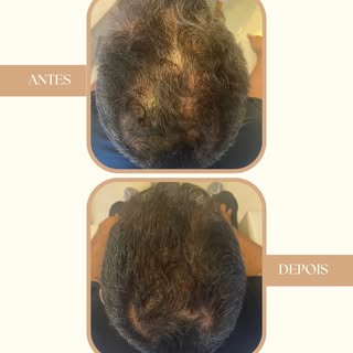 📍 Paciente com Alopecia Androgenética Masculina (calvície). 

👉🏻 Resultado com 3 sessões de terap