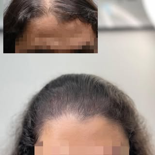 Scalp Micropigmentation is for everyone going through hair loss. If you are send us a DM for free co
