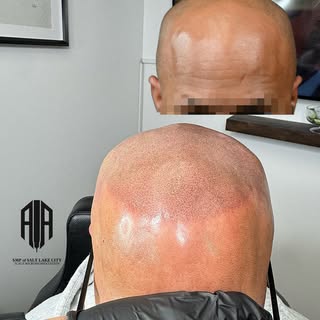 Natural results. Sharp lineup.
SMP that blends seamlessly with your hair.
✔️ No surgery
✔️ No downti