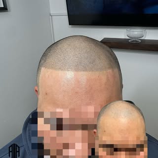 He didn’t lose his hair… he upgraded his look 🔥
Crisp lineup + density fill = instant confidence.
R