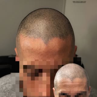 Clean, natural, and confidence restored 💯

Subtle hairline work with detailed density to bring ever