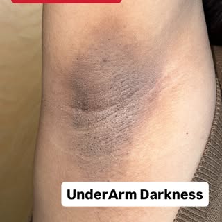 Underarm darkness treatment