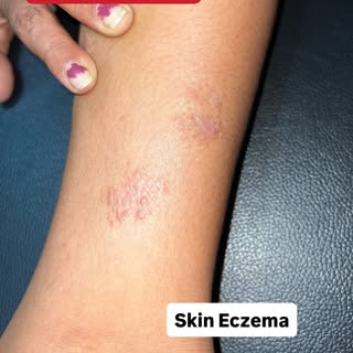 Skin dermatitis treatment @drkuldeepsingh.medskinclinic