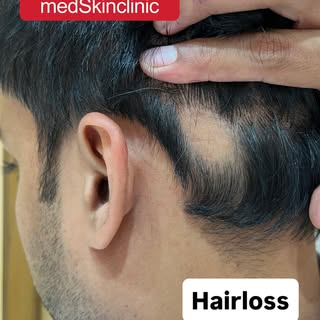 HAIR REGROWTH TREATMENT @drkuldeepsingh.medskinclinic