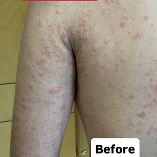 Skin Allergy treatment @drkuldeepsingh.medskinclinic #dermatologist