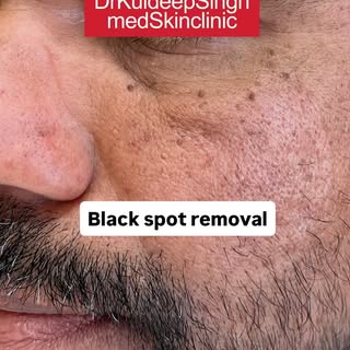 For appointment call on 9909905404 @drkuldeepsingh.medskinclinic