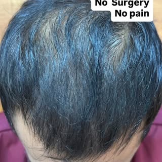 Hair regrowth without surgery with latest exosomes treatment @drkuldeepsingh.medskinclinic  call on 