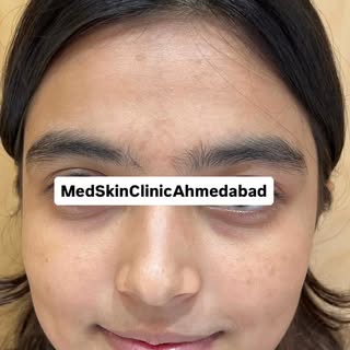 Skin treatment @drkuldeepsingh.medskinclinic call on 9099189998 for appointment #dermatologist #ahme