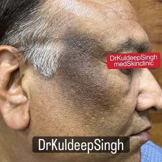 Pigmentation Treatment @drkuldeepsingh.medskinclinic