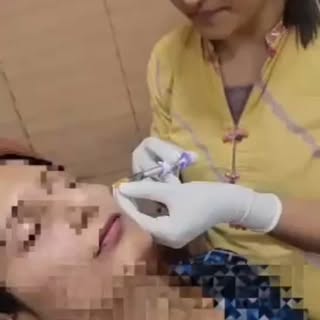 Dermal fillers#antiaging#for volume loss#under eye hollowness#under eye dark circles