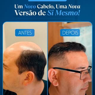 Após 11 meses do transplante capilar, nosso paciente, que anteriormente enfrentava uma calvície exte