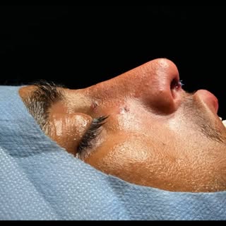 Not a different face—just a better balance. Tailored rhinoplasty for every unique profile.

#Natural