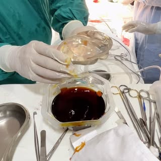 #drhusnainkhan #brest implants #* “Confidence isn’t about changing who you are—it’s about enhancing 